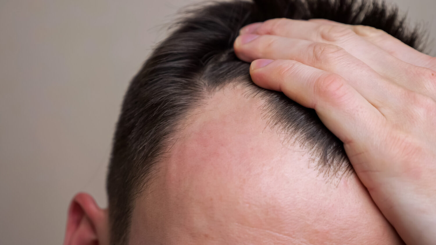 How To Avoid Hair Loss in Men • The Hair Addict